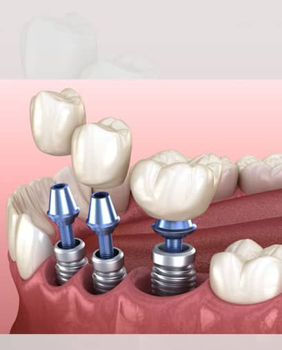 Treatements  - ninety2dental